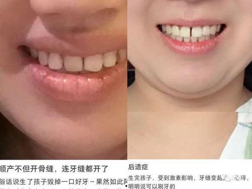 箍牙网红,揭秘矫正牙齿的美丽蜕变之旅